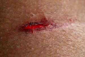 a close up of a skin tear wound