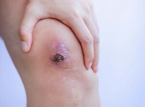 injured knee with a wound showing eschar