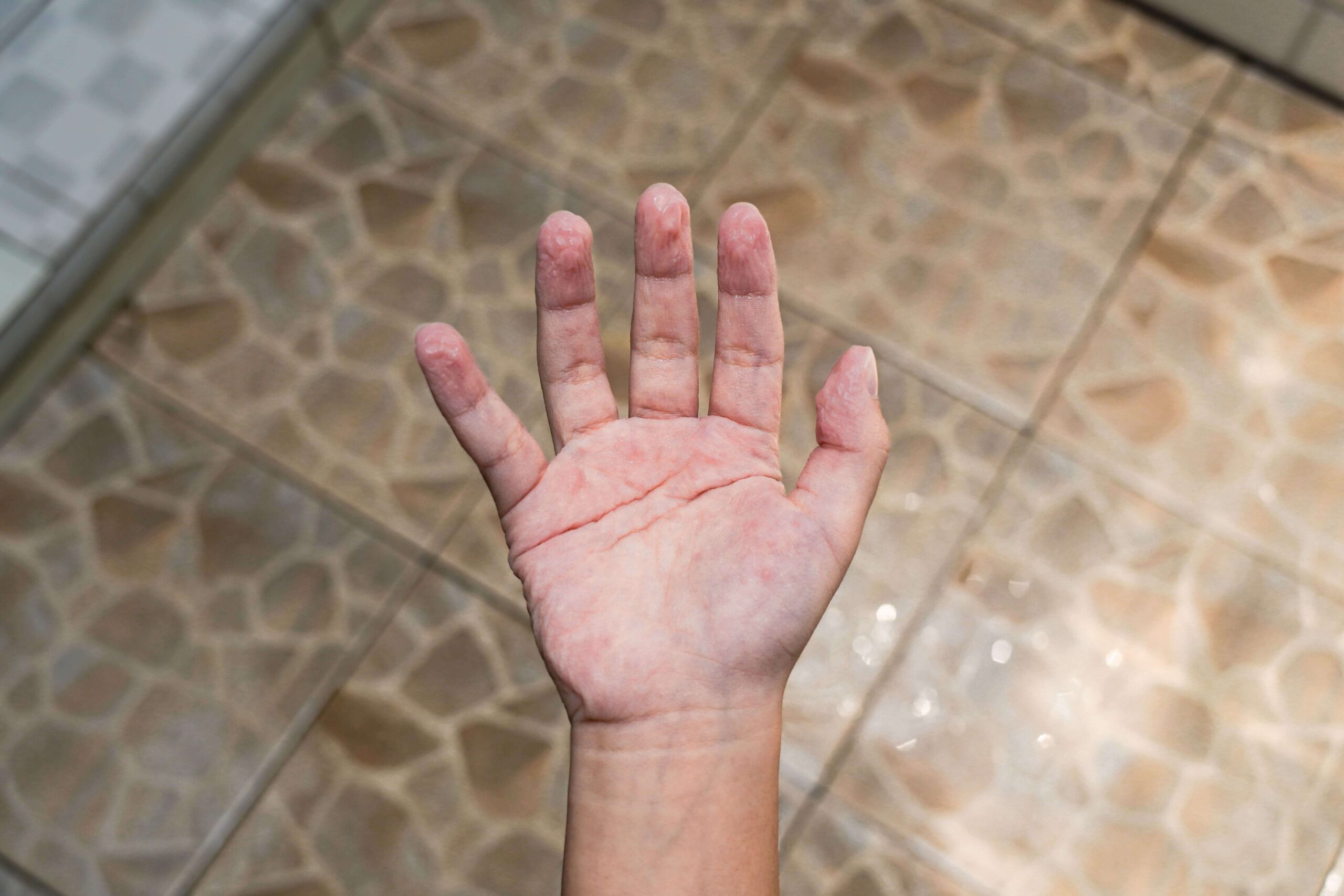 hand with macerated skin