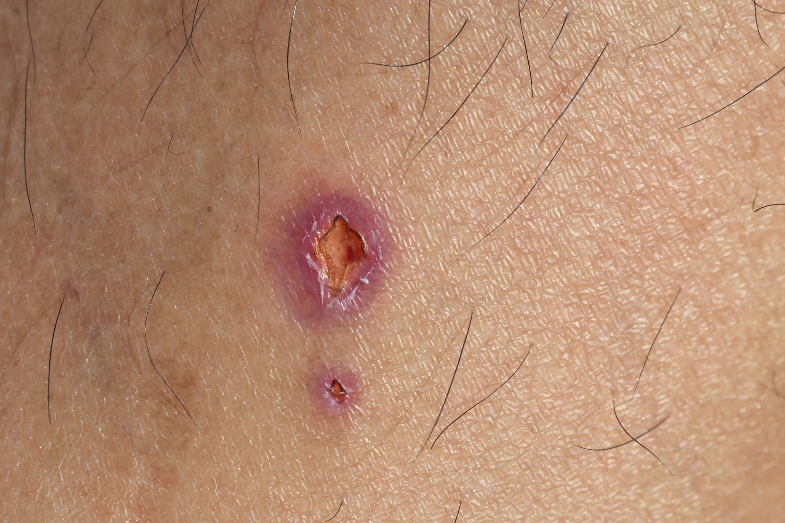 infected wound with granulation tissue